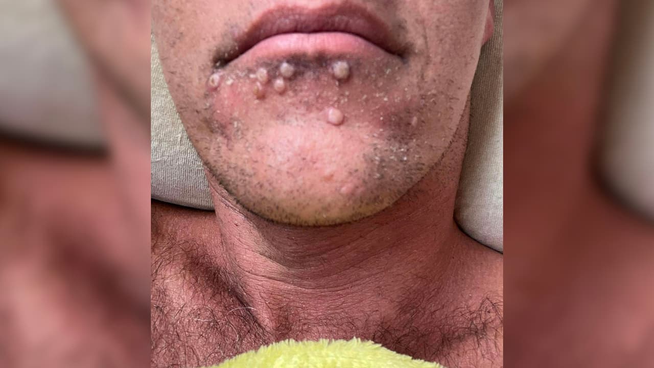 Tenía fiebre, escalofríos, sudaba durante la noche, además de dolores de cabeza: "todos los síntomas que has leído sobre la viruela del mono yo los tenía, cada uno de ellos", explica el hombre.