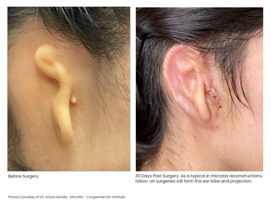 Mexicana recibe "trasplante revolucionario" de oreja impresa en 3D fabricada con sus propias células