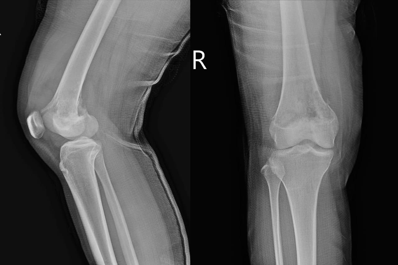 <h3 class="cms-H3-H3">25. Cáncer de hueso y tejido conectivo</h3>
<br>
<br>🏥 
<b>Crecimiento en costo por caso de acuerdo con el Índice de Gastos Médicos: </b>3.28
<br>
<br>🏥 
<b>Aumento del gasto en los últimos 10 años registrados: </b>72.4%
<br>