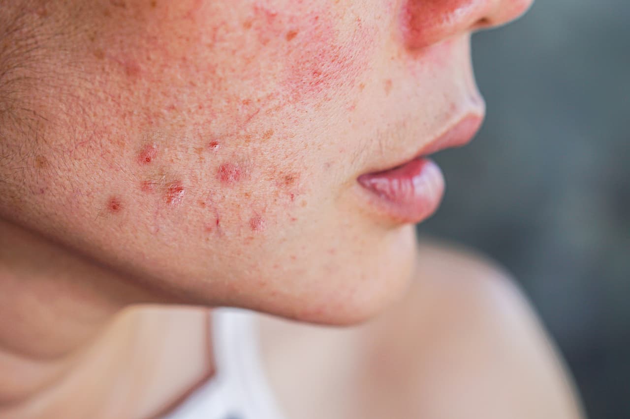 <h3 class="cms-H3-H3">10. Condiciones inflamatorias de la piel</h3>
<br>
<br>🏥 
<b>Crecimiento en costo por caso de acuerdo con el Índice de Gastos Médicos: </b>4.37
<br>
<br>🏥 
<b>Aumento del gasto en los últimos 10 años registrados: </b>134.4%
<br>