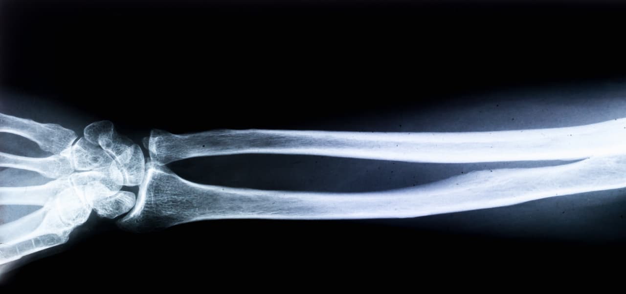<h3 class="cms-H3-H3">10. Rayos X</h3>
<br>
<br>Mientras replicaba un experimento realizado anteriormente con un tubo de rayos catódicos cubierto por una ventana de aluminio y un trozo de cartón, el físico alemán Wilhelm Röntgen notó una luz verde brillante en una hoja de papel en la habitación. 
<br>
<br>Röntgen sabía que los rayos catódicos no podían viajar tan lejos –especialmente a través del cartón–, entonces llamó a los rayos desconocidos radiación X y comenzó a probar materiales que los rayos podían penetrar. Mientras sostenía un trozo de plomo, Röntgen vio sin darse cuenta la primera imagen radiográfica: su propia mano esquelética. Procedió a capturar imágenes en placas fotográficas, creando las radiografías.
