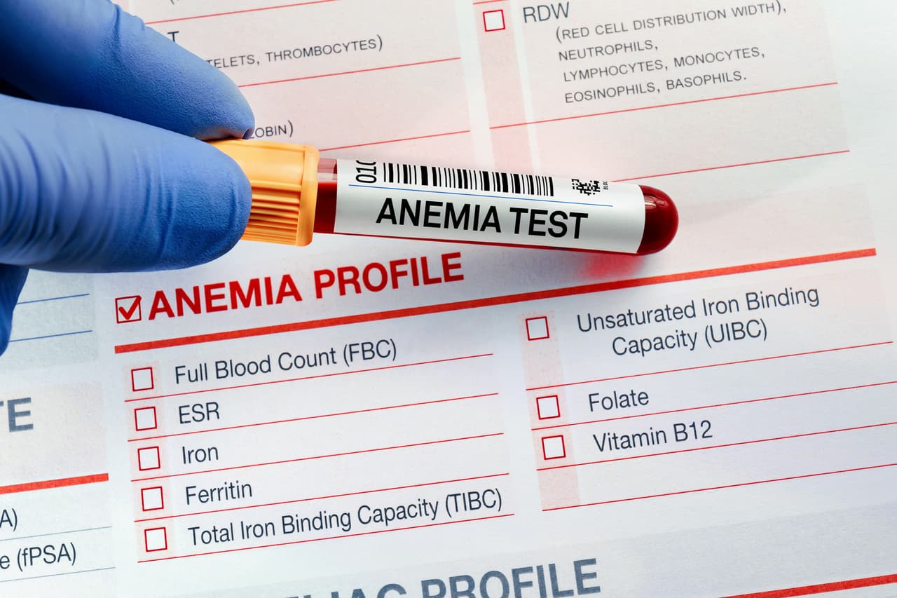 <h3 class="cms-H3-H3">21. Anemia poshemorrágica aguda</h3>
<br>
<br>🏥
<b> Crecimiento en costo por caso de acuerdo con el Índice de Gastos Médicos: </b>3.42
<br>
<br>🏥
<b> Aumento del gasto en los últimos 10 años registrados:</b> 73.7%
<br>
