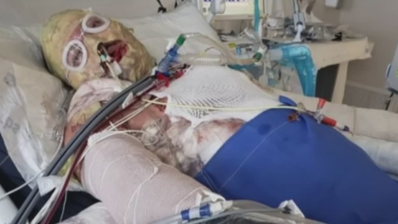 En enero de 2019 el joven Alexis Hernández llegó a Guadalajara, México, a estudiar medicina, pero dos días después encendió el calentador de agua en su apartamento y se desató una explosión que lo dejó con quemaduras en el 70% de su cuerpo. Fue trasladado a EEUU para el tratamiento médico, pero ahora debe más de 1.7 millones de dólares por la atención que recibió.