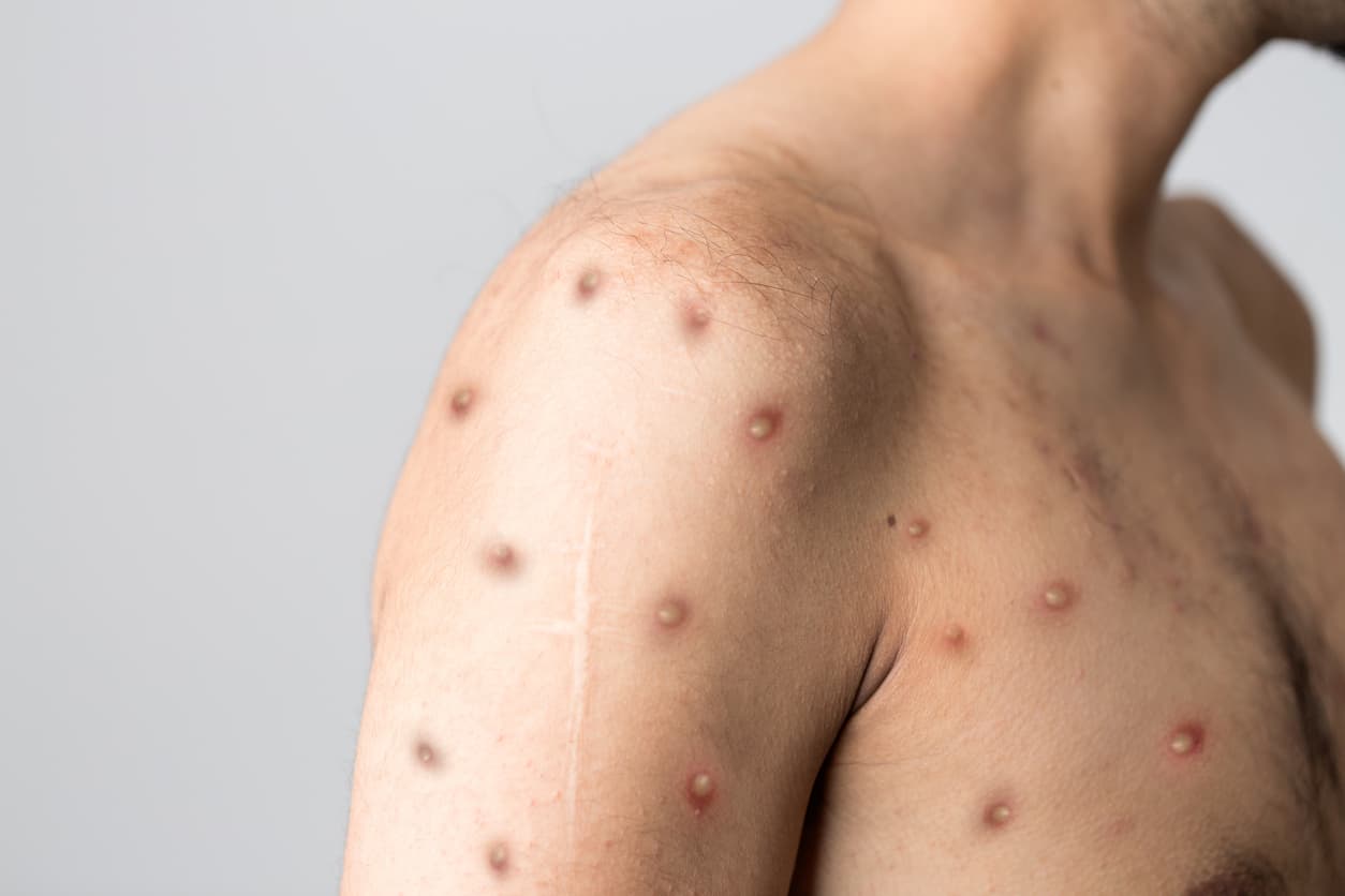 En algunos brotes anteriores, la viruela del mono comenzaba con síntomas similares a los de la gripe.