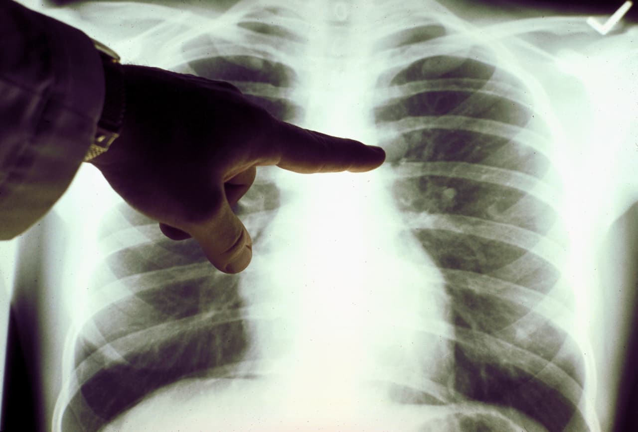 <b>5. CÁNCER DE PULMÓN, DE TRÁQUEA Y DE BRONQUIOS</b>: Estos tipos de cáncer causaron la defunción de 
<a href="http://www.who.int/mediacentre/factsheets/fs310/es/"><u>1,7 millones de personas en el mundo en 2015</u></a>.