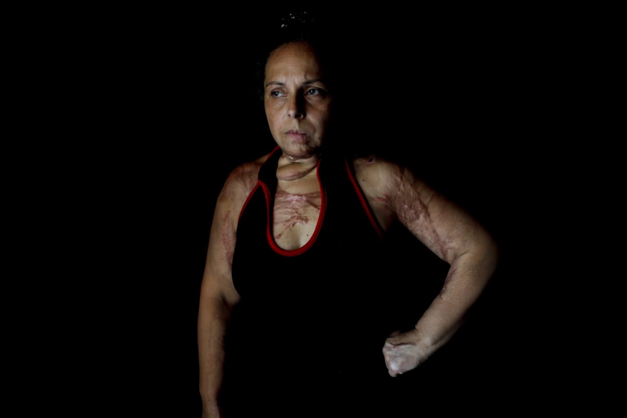 El 55% del cuerpo de Karina Abregu fue quemado por su marido. Había sufrido años de maltrato y aunque informó de 14 incidentes en el transcurso de 14 años, la policía no hizo nada hasta dos meses después del ataque en el que su cuerpo sufrió las quemaduras. Todavía en tratamiento médico, asegura que la policía ignoró sus llamadas de ayuda. Desde hace dos años recibe protección de las autoridades, quienes mantienen policías fuera de su casa.