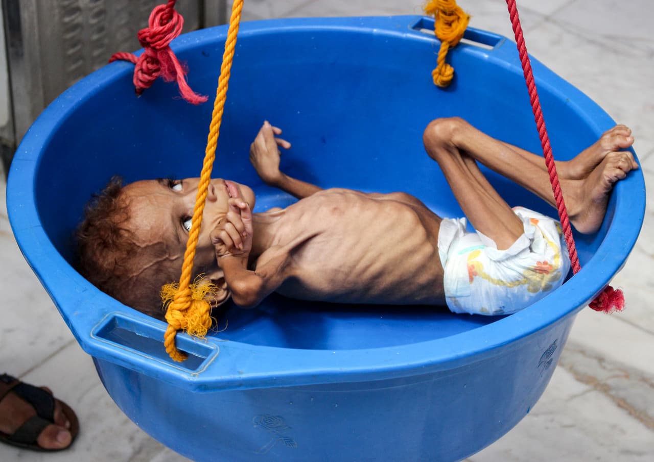 <b>Hambre y guerra:</b> Según Unicef más de 5,000 niños han muerto desde el inicio de la guerra civil en Yemen, que todavía continúa. Más de dos millones sufren de desnutrición y de estos, 360,000 son menores de cinco años.