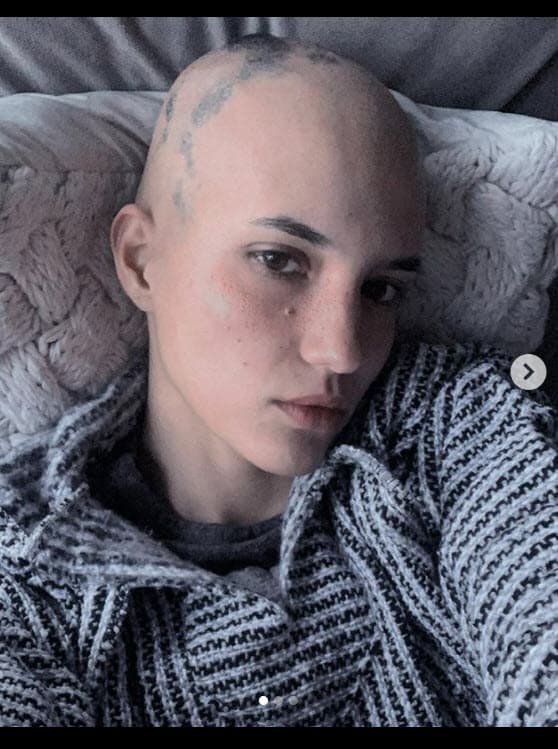 La alopecia areta que padece la modelo provoca "la 
<b>caída del pelo</b>, por lo general, en la cabeza y la cara", de acuerdo con el Instituto Nacional de Artritis y Enfermedades Musculoesqueléticas y de la Piel de EEUU.