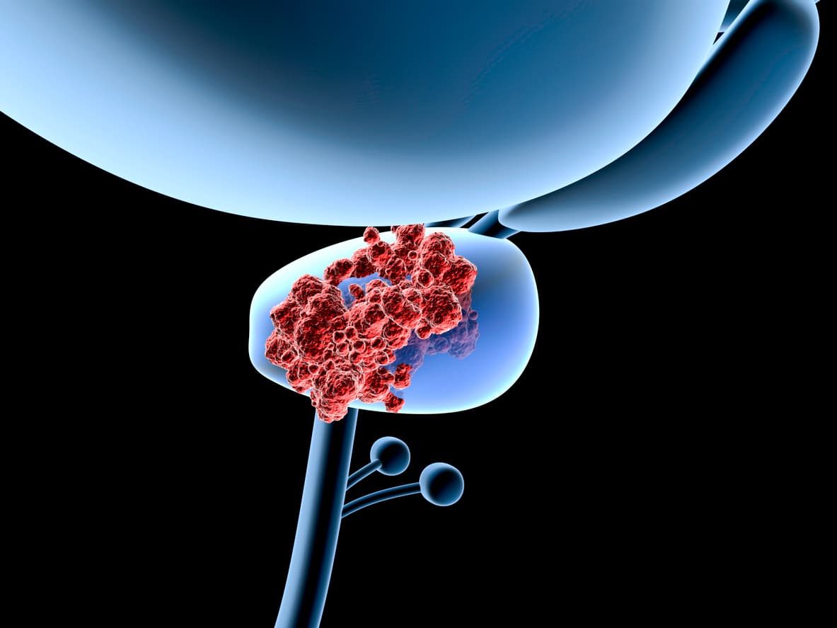 <b>El riesgo de <a href="https://www.univision.com/noticias/salud/kirstie-alley-cancer-colorrectal">morir de cáncer</a> es mayor para las personas más altas.</b> Ser alto puede ser un marcador de sobrealimentación (específicamente, comer demasiadas proteínas animales ricas en calorías) durante diferentes etapas de crecimiento y desarrollo, ya sea a lo largo de la vida o antes del nacimiento. Esto podría activar procesos de crecimiento que incrementan la vulnerabilidad de las células a las mutaciones. 
<br>
<br>Algunos estudios también han descubierto que 
<b>los hombres altos (y en particular los que también son obesos) tienen un mayor riesgo de desarrollar formas agresivas de cáncer de próstata,</b> y que las mujeres altas son más propensas a desarrollar 
<b>melanoma, así como cáncer de mama, ovario, endometrio y colon.</b>