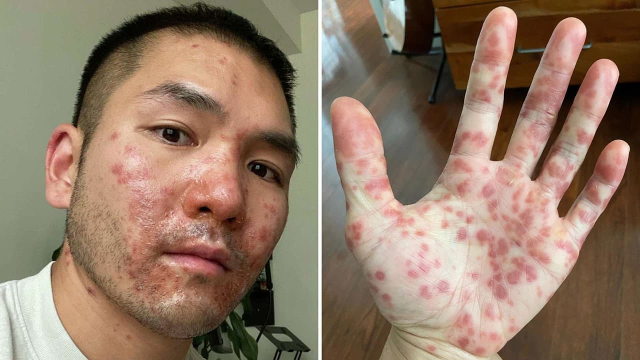 “Me siento miserable”: residente del Área de la Bahía se muestra con la viruela del mono y cuenta cómo se contagió