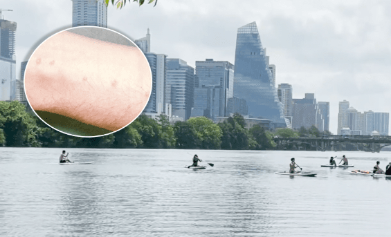 <b>¿Qué es el Swimmers Itch'?</b>
<br>
<br>Una doctora explica qué es el 'Swimmers Itch', una condición que puede afectar a nadadores durante la época de verano en lagos y ríos de Texas.