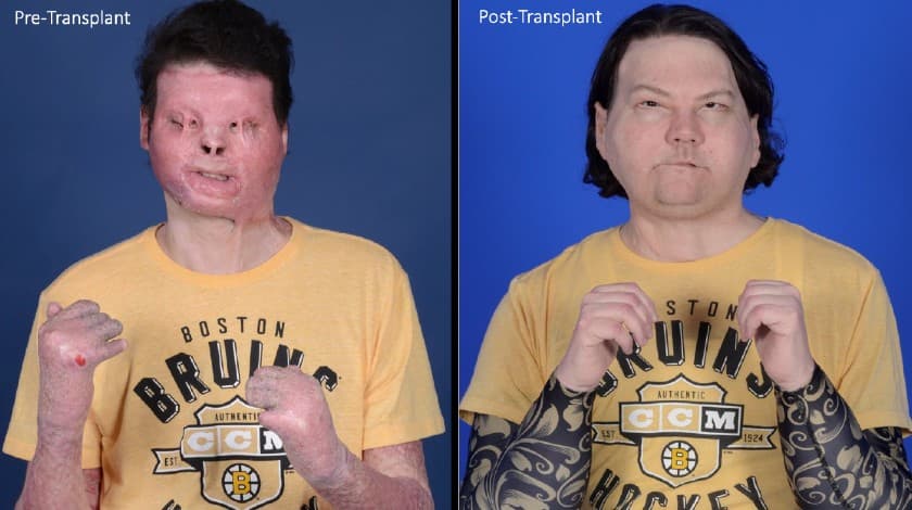 El doctor Rodríguez cuenta que fue entonces cuando le plantearon la posibilidad de realizar dos arriesgados 
<a href="https://www.univision.com/temas/trasplantes">trasplantes</a>: el de rostro y manos, que se habían intentado solo dos veces en el mundo con riesgo de muerte. 
<b>Los trasplantes de rostro son unos de los procedimientos más inusuales en la cirugía</b>. Uno de los problemas más recurrentes es el de 
<b>encontrar un donante</b>. Ya entrado 2020, los médicos se enfrentaron al problema de hallar donantes a causa de la pandemia de 
<a href="https://www.univision.com/temas/coronavirus">covid-19</a>.