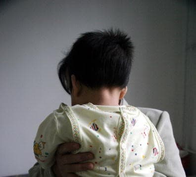 Doctores hallan un feto dentro del cráneo de una niña: ¿cómo es posible?