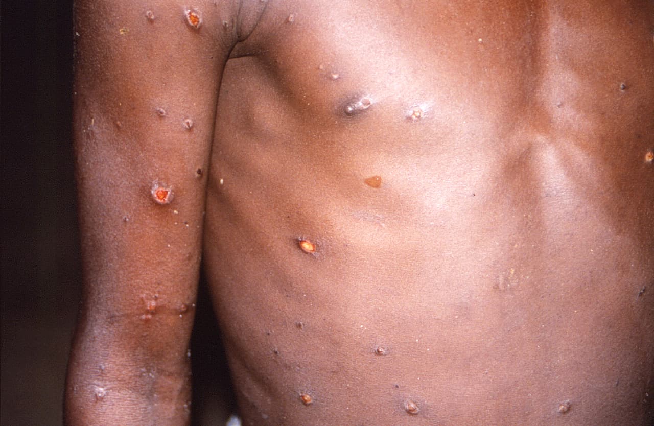 Viruela del mono en Utah: Todo lo que debes saber sobre el avance del virus