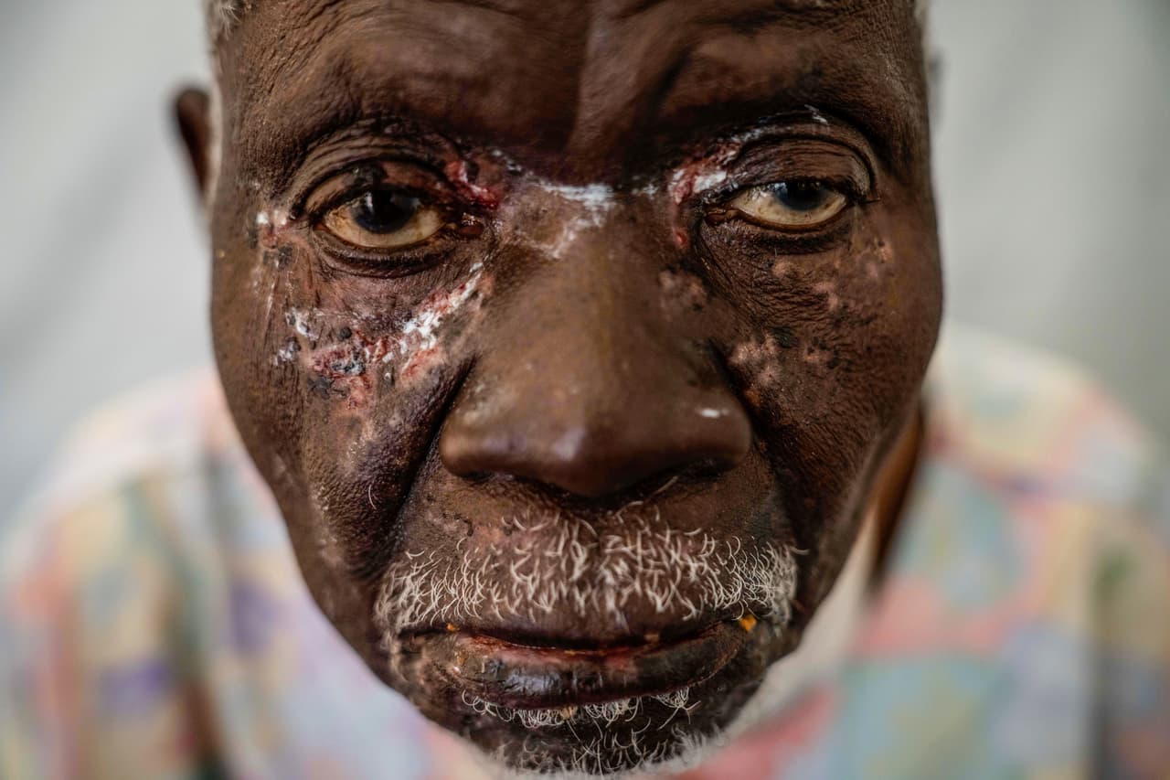 Christophe Chavilinga, de 90 años, contagiado de 'mpox', viruela símica en Munigi, Congo. Es una enfermedad viral que pertenece a la misma familia de la viruela. Es endémica en partes de África, donde la gente se infecta por mordeduras de roedores. Los síntomas van desde fiebres y dolores hasta lesiones en rostro, manos y genitales. En 2024 se detectó la aparición de una 
<a href="https://www.univision.com/noticias/salud/que-se-sabe-sobre-el-caso-del-nuevo-tipo-de-viruela-simica-o-mpox-registrado-en-california-eeuu">nueva forma de viruela símica que se transmite por contacto,</a> incluido el contacto sexual, lo que llevó a la OMS a declarar una emergencia de salud mundial en agosto.