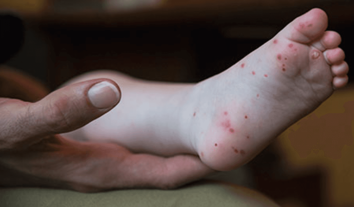Su síntoma más característico es un sarpullido que no pica, de puntitos rojos en la palma de las manos y los pies, y a veces en las rodillas, codos, nalgas o el área genital. También dolorosas llagas en la boca que normalmente comienzan como puntitos rojos planos. 
<br>