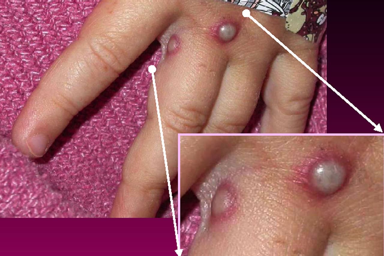 <b>¿Qué es la viruela símica?</b> 
<a href="https://www.who.int/es/news-room/fact-sheets/detail/monkeypox" target="_blank">Según la Organización Mundial de Salud (OMS),</a> por sus siglas en inglés, la viruela símica es una enfermedad rara que se da principalmente en las zonas remotas de África central y occidental, cerca de las selvas tropicales. 
<br>