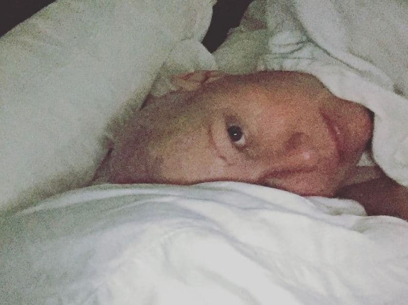 Durante su lucha contra el cáncer, Doherty compartió varias fotos de su cabeza sin pelo, como ésta con la que recordó la mañana del 7 de octubre de 2016, el último día de quimioterapia.