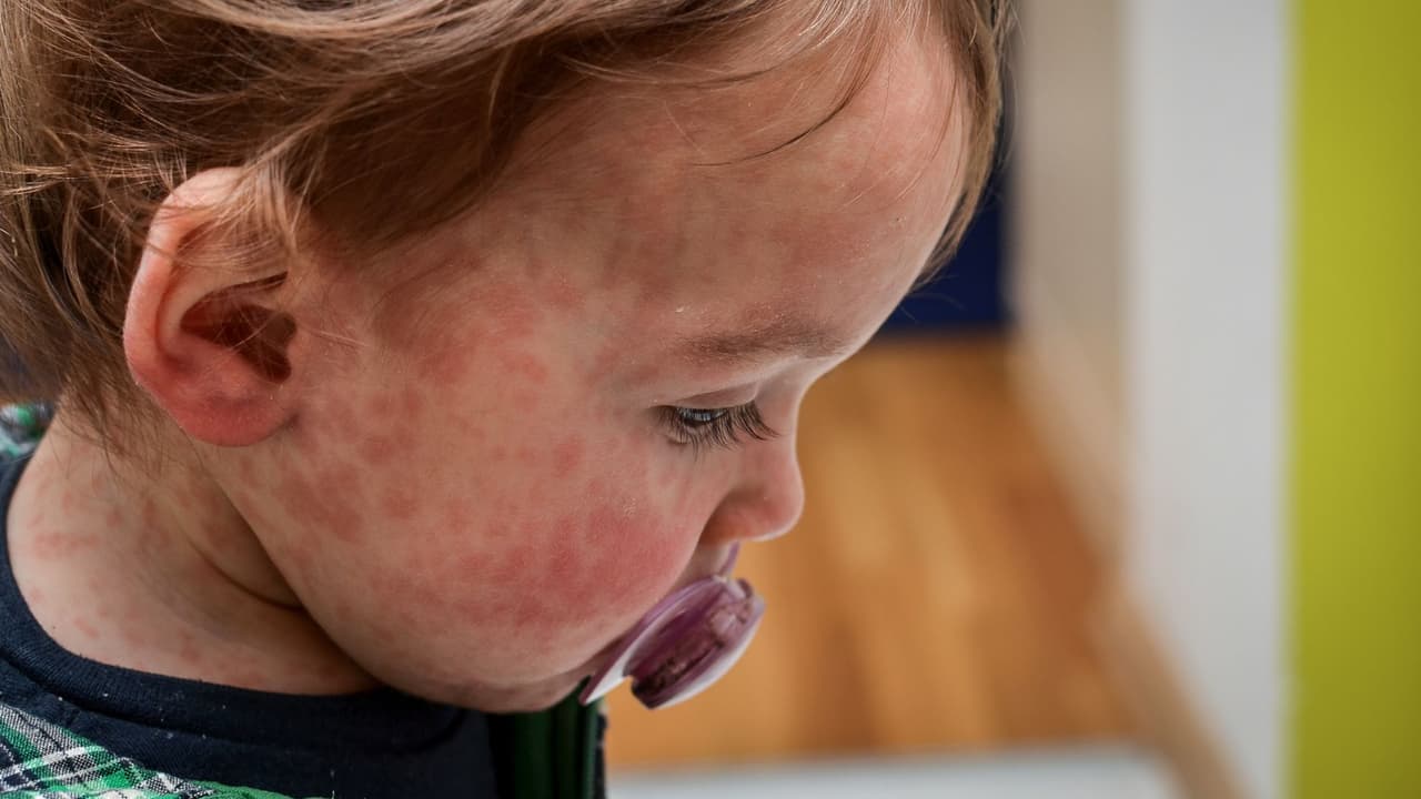 El sarampión está de vuelta: estos son los síntomas y complicaciones a los que debes estar alerta