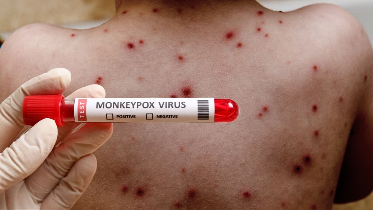 Salud expande elegibilidad para la vacuna de la viruela del mono; ¿perteneces a grupos de alto riesgo? 