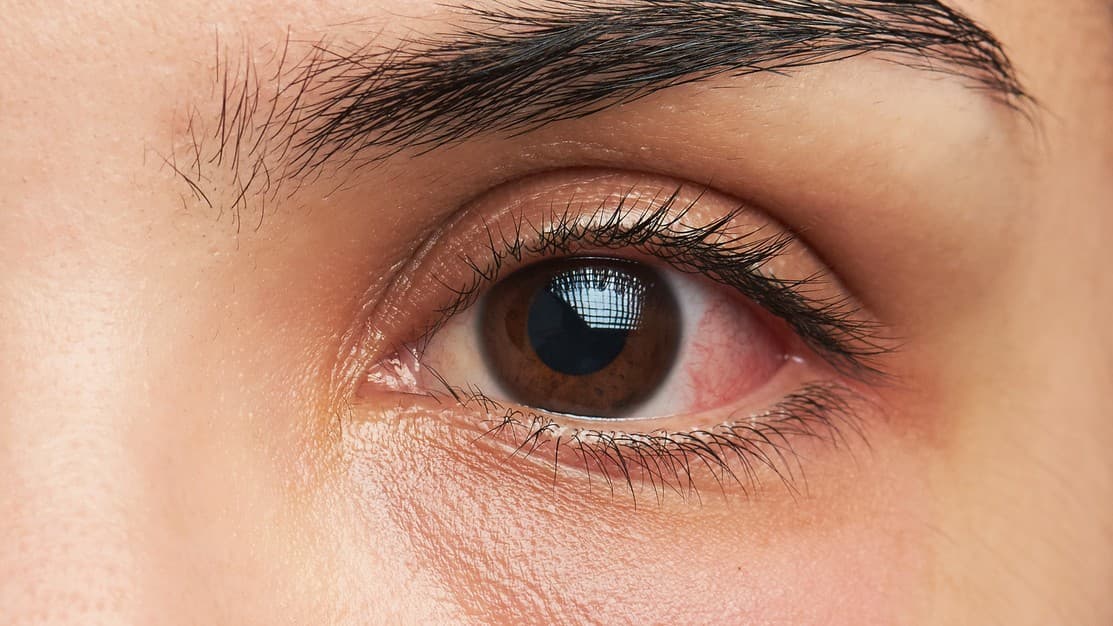 Aumentan los casos de conjuntivitis en Puerto Rico: ¿por qué el Covid-19 y el Polvo del Sahara podrían ser los responsables?