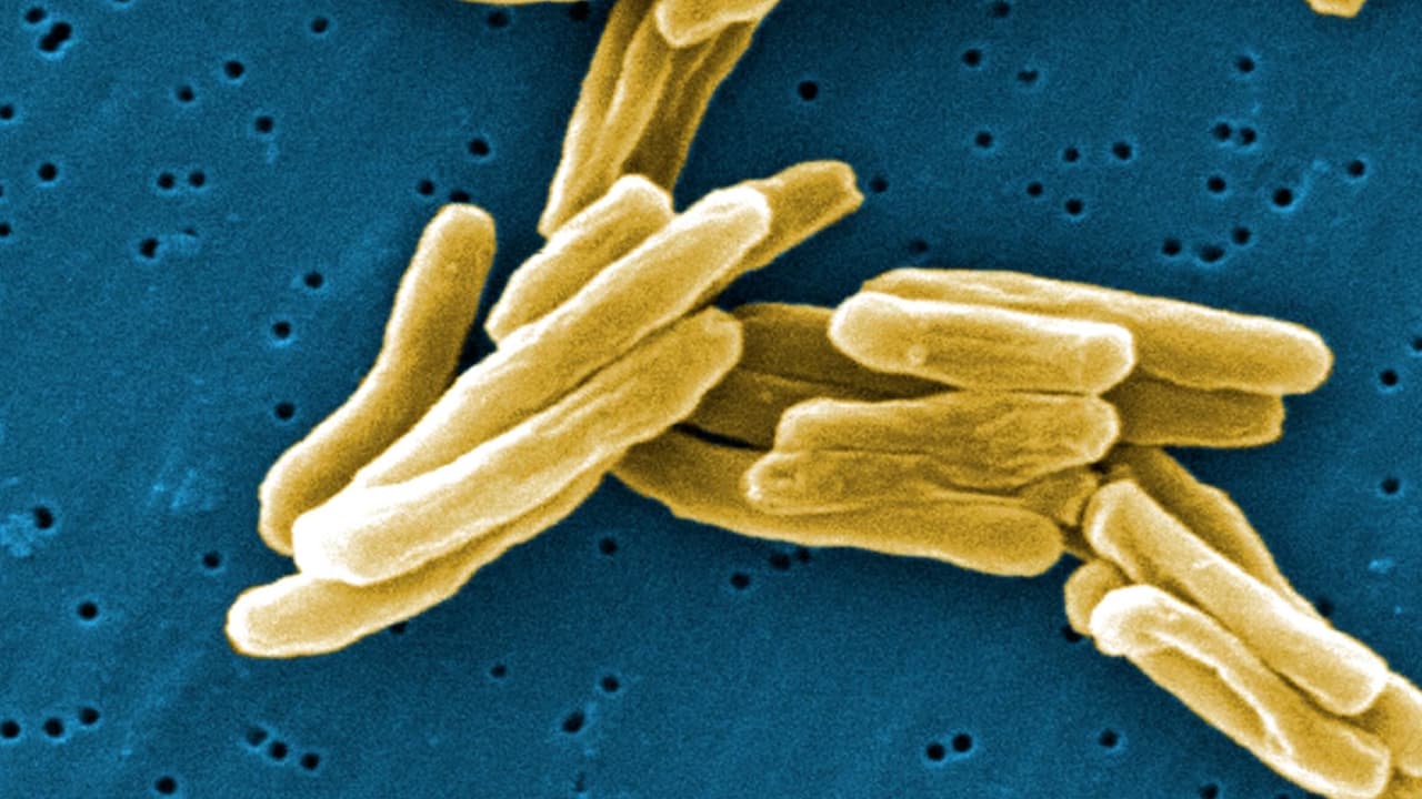 Brote mortal en EEUU: en qué consiste la tuberculosis y cuáles son sus efectos