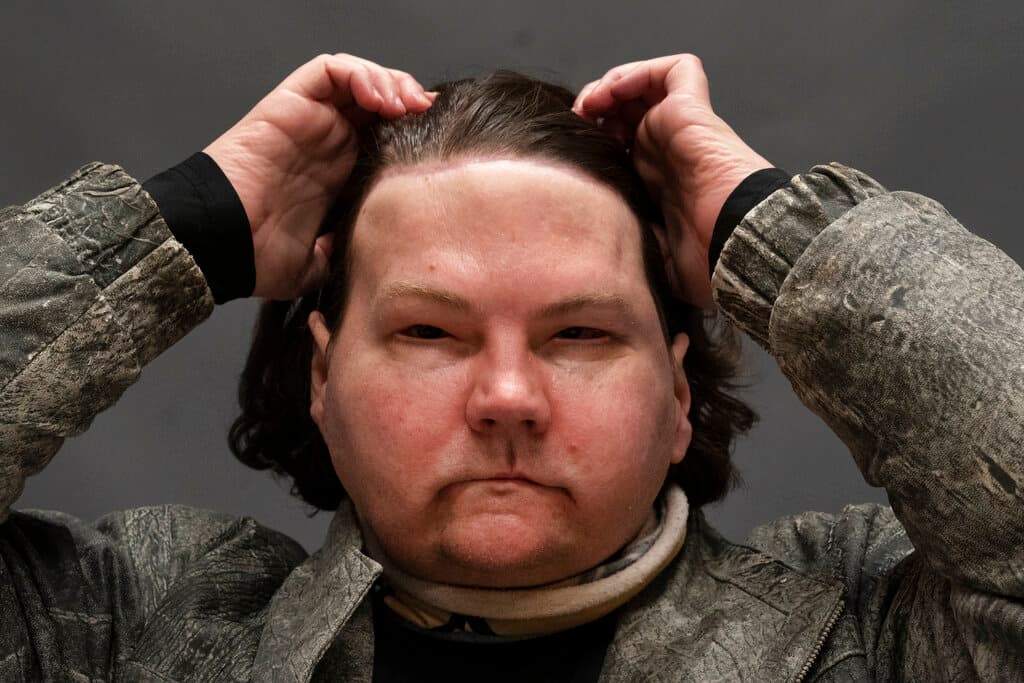 A principios agosto, el equipo médico del doctor Rodríguez 
<b>halló al posible donante en Delaware</b> y, el día 12 de ese mismo mes, llevaron a cabo el procedimiento quirúrgico que habían ensayado durante meses
<b> que tomó 23 horas. </b>A 
<b>DiMeo le amputaron ambas manos, reemplazándolas en la mitad del antebrazo y conectando nervios, vasos sanguíneos y 21 tendones </b>con suturas delgadas como un cabello. También realizaron el trasplante de
<b> cara completa, incluida la frente, las cejas, la nariz, los párpados, los labios, las orejas y los huesos faciales subyacentes.</b>