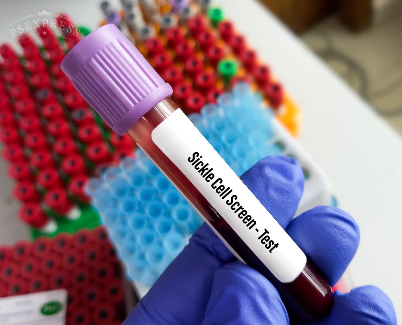 <h3 class="cms-H3-H3">8. Anemia falciforme</h3>
<br>
<br>🏥 
<b>Crecimiento en costo por caso de acuerdo con el Índice de Gastos Médicos: </b>4.80
<br>
<br>🏥 
<b>Aumento del gasto en los últimos 10 años registrados: </b>74.4%