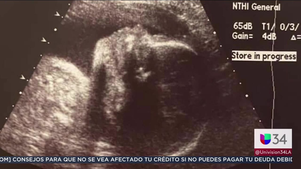 Los médicos realizaron una cesárea de emergencia, para extraer a la bebé del cuerpo de su madre. De acuerdo con Jaime, la infanta tuvo "20 minutos sin vida" y los médicos trataron de resucitarla.