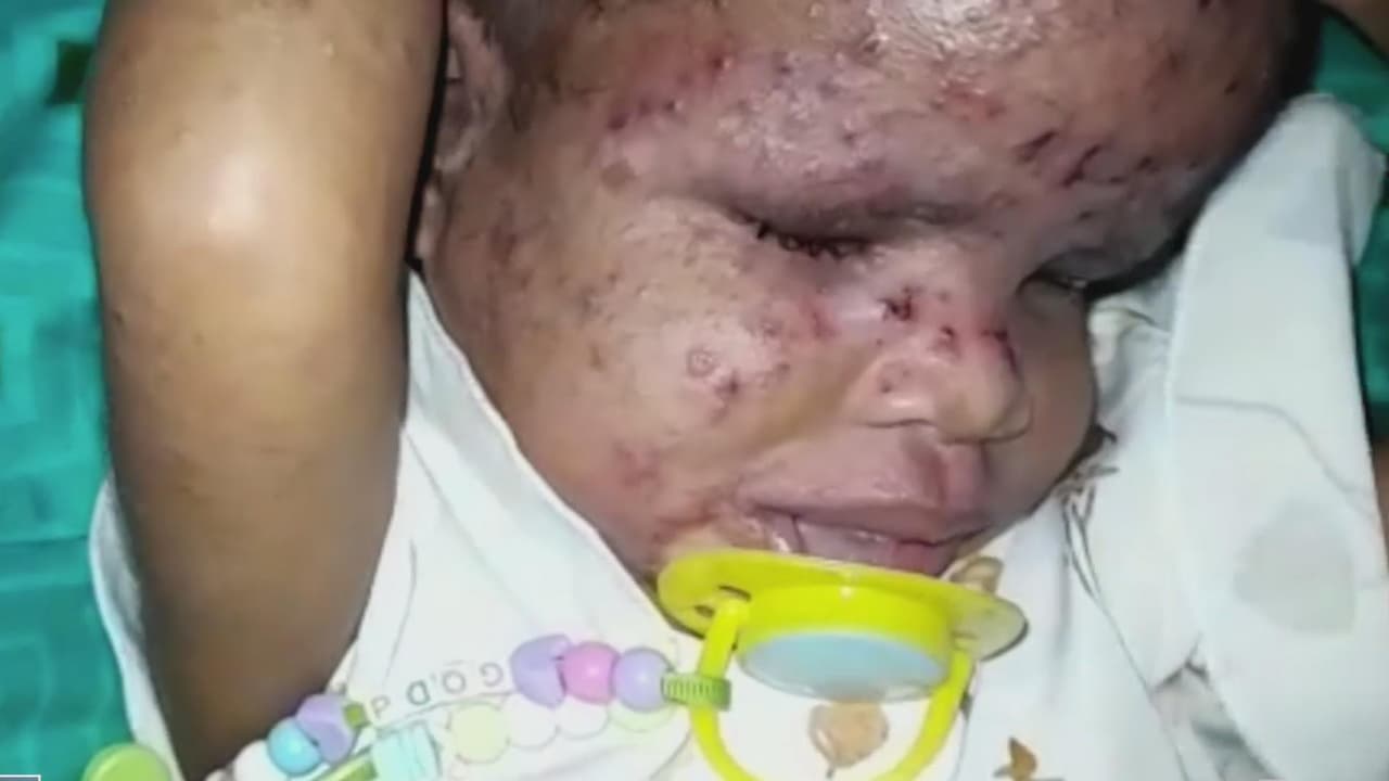 La familia es muy pobre y no tiene los recursos para pagar los costosos tratamientos que necesita para tener una mejor vida. Los doctores intentan averiguar por qué nació sin ojos.