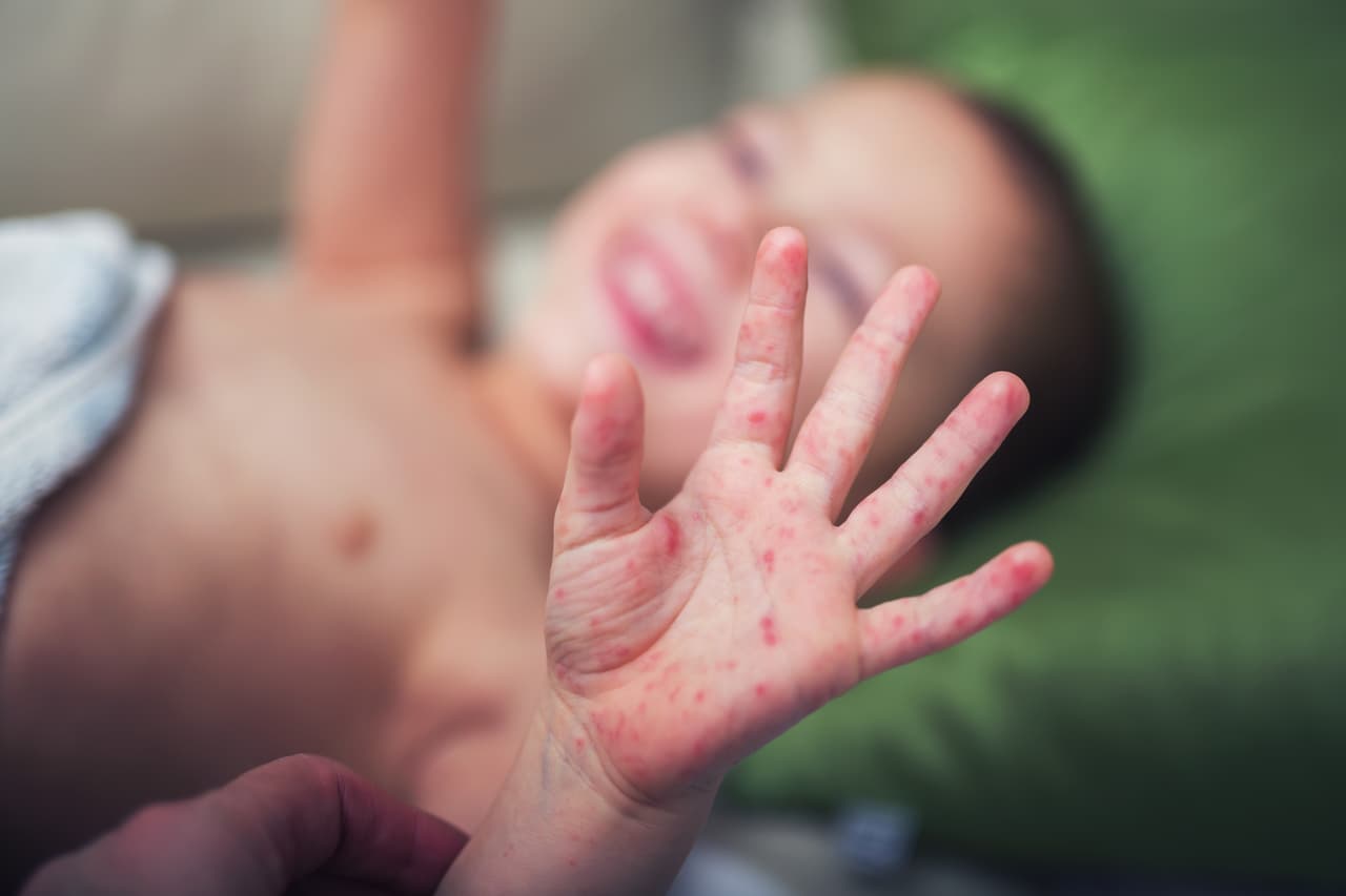 Los Ángeles, San Francisco y Sacramento entre los 11 condados con casos de sarampión confirmados en California
