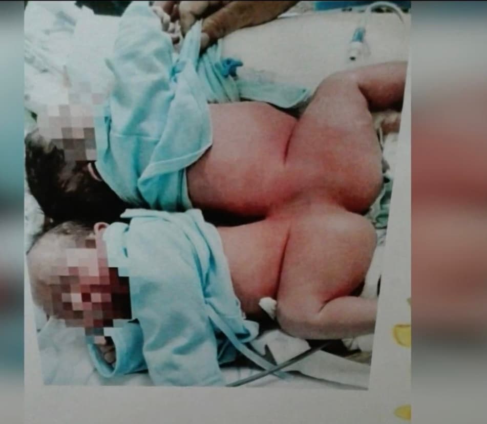 A pesar de las preocupaciones, Espinoza rememoró que al tener éxito en la cirugía 
<b>“todo el equipo comprobó que los niños controlaban por si solos sus extremidades inferiores". </b>
<br>