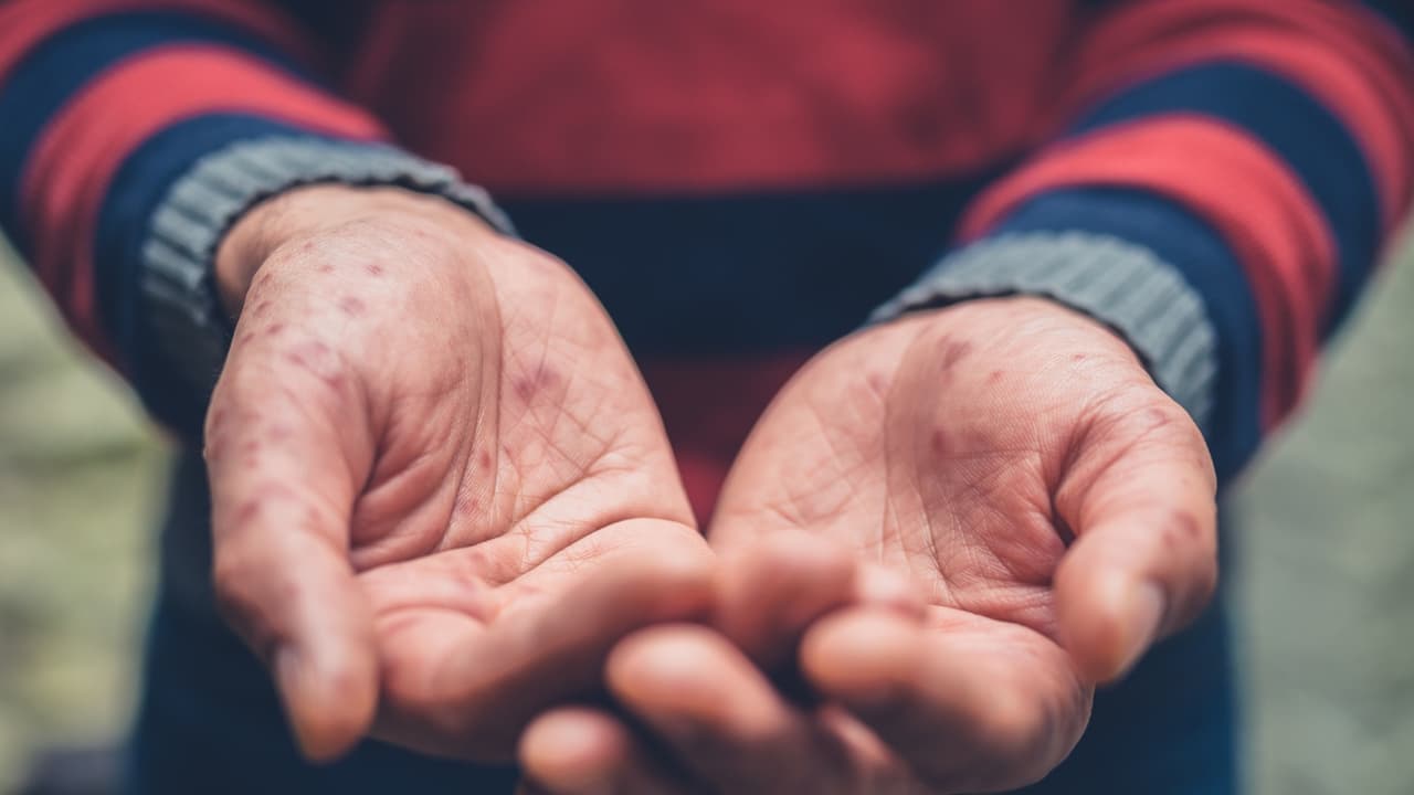 <b>¿Qué es el sarampión? </b>
<br>El sarampión es una enfermedad altamente contagiosa pero prevenible por vacuna que se propaga a través de la tos, los estornudos u otro contacto con la mucosidad o la saliva de una persona infectada.
<br>