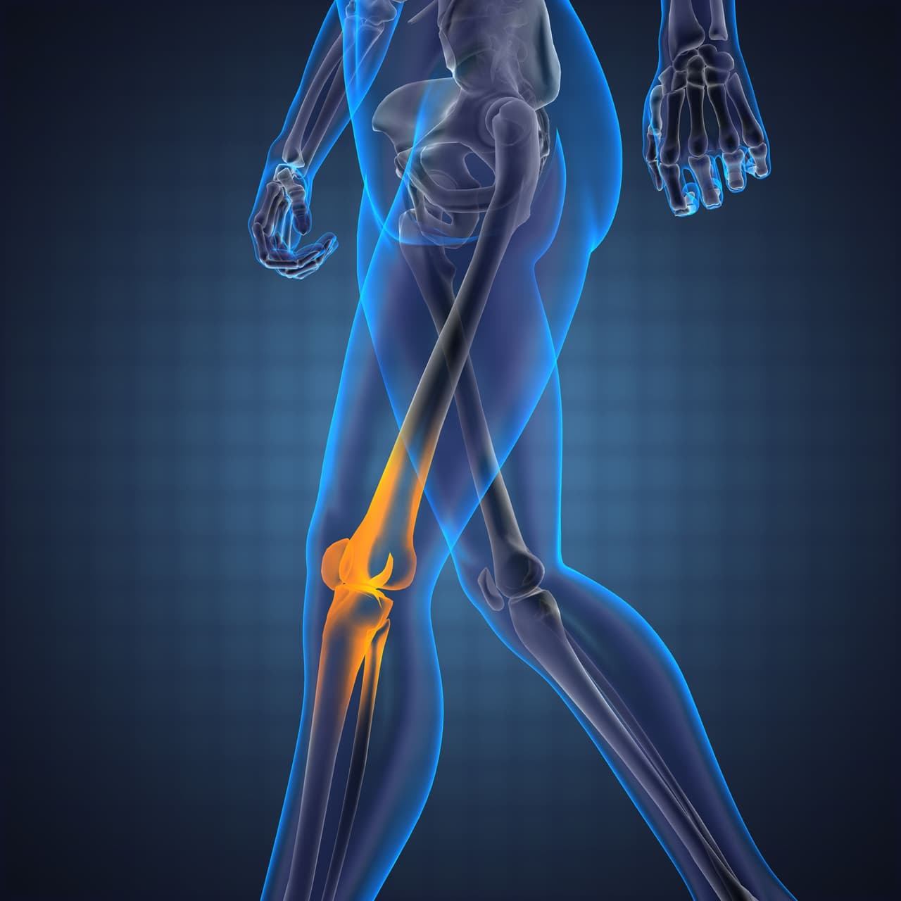 Osteoporosis: estos son los alimentos que debemos consumir para prevenirla