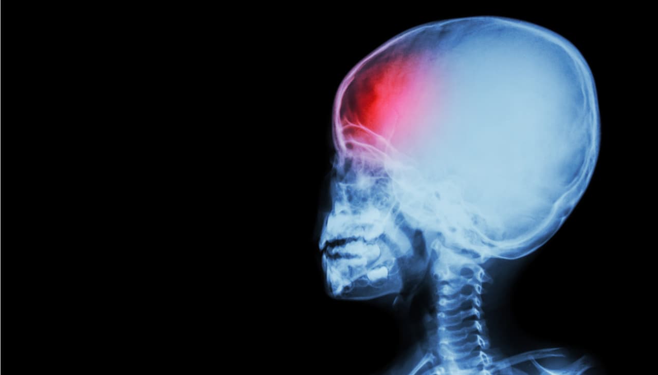 Los accidentes cerebrovasculares se pueden prevenir si identificas los síntomas más sutiles