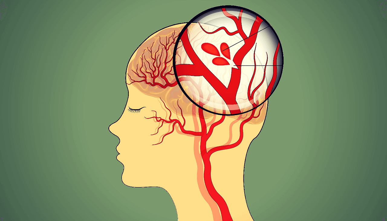 Síntomas silenciosos de un accidente cerebrovascular que debes conocer para evitar secuelas