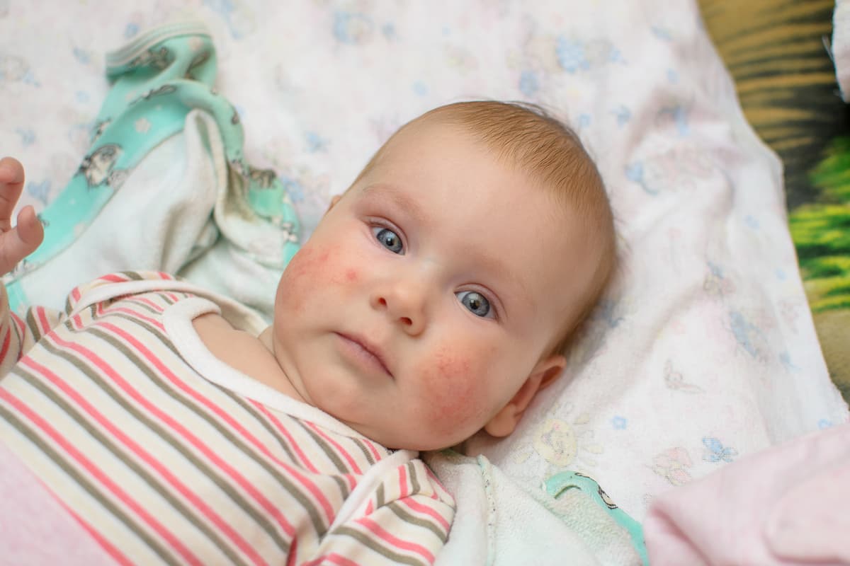 8 alimentos que los bebés con dermatitis atópica deben evitar (son muy peligrosos)