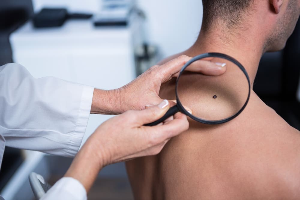 Descubren cómo detectar si el cáncer de piel causará metástasis