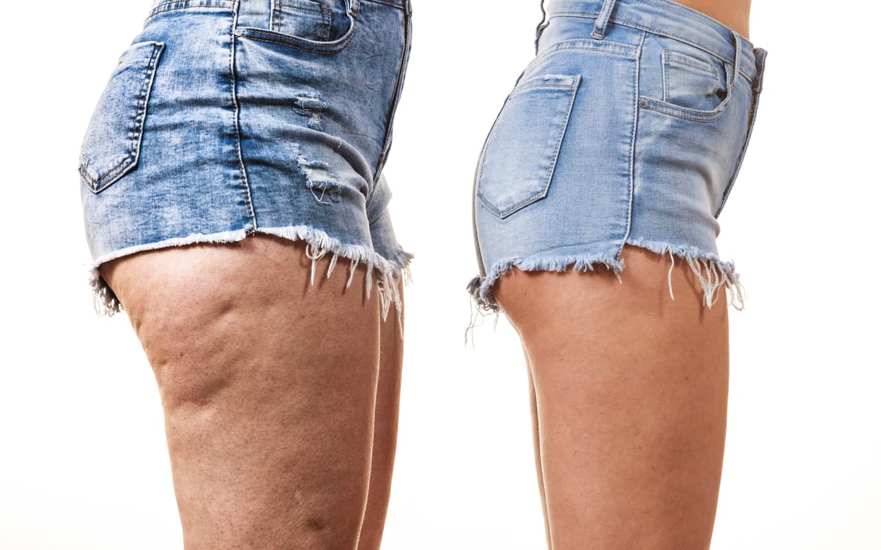 5 alimentos que parecen inofensivos, pero pueden empeorar la celulitis