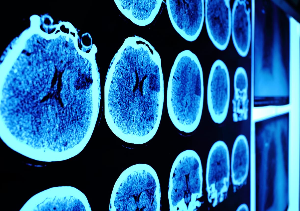 ¿Es posible recuperar la memoria? Prótesis cerebral abre la puerta a esa posibilidad 
