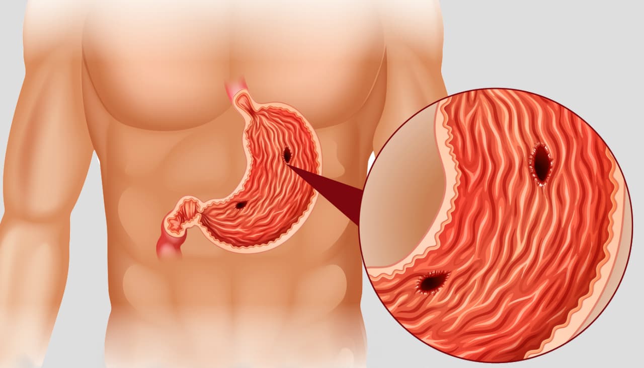 Influencer descubrió cáncer grave tras dolor de panza, que puede comenzar con acidez