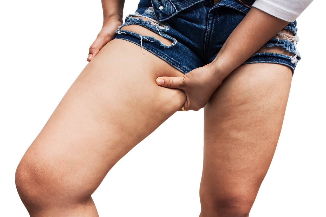 ¿Sufres de rozaduras en los muslos? 6 consejos para resolver el problema de una vez por todas