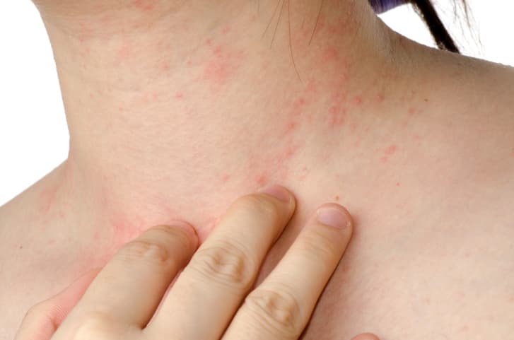 Alergia a la zanahoria: aprende cómo detectar los síntomas más frecuentes