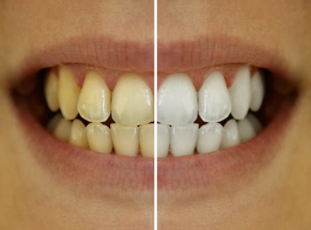 Tener los dientes blancos no necesariamente significa una buena salud bucal: especialista