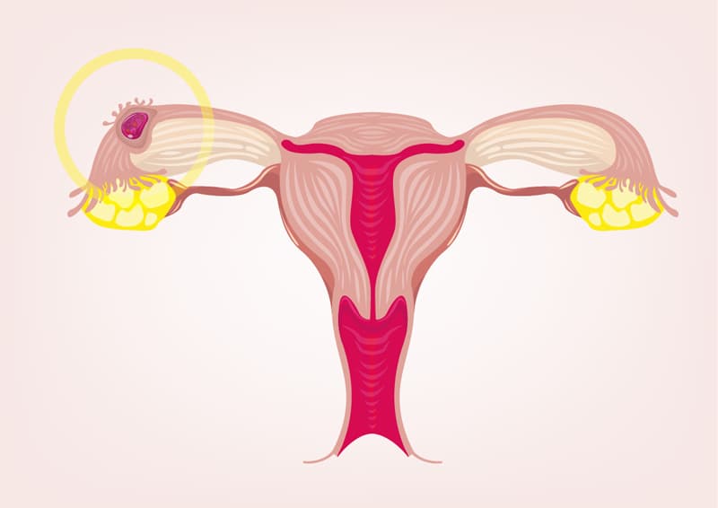 El embarazo ectópico pone en riesgo la vida de sus mujeres: estas son sus causas