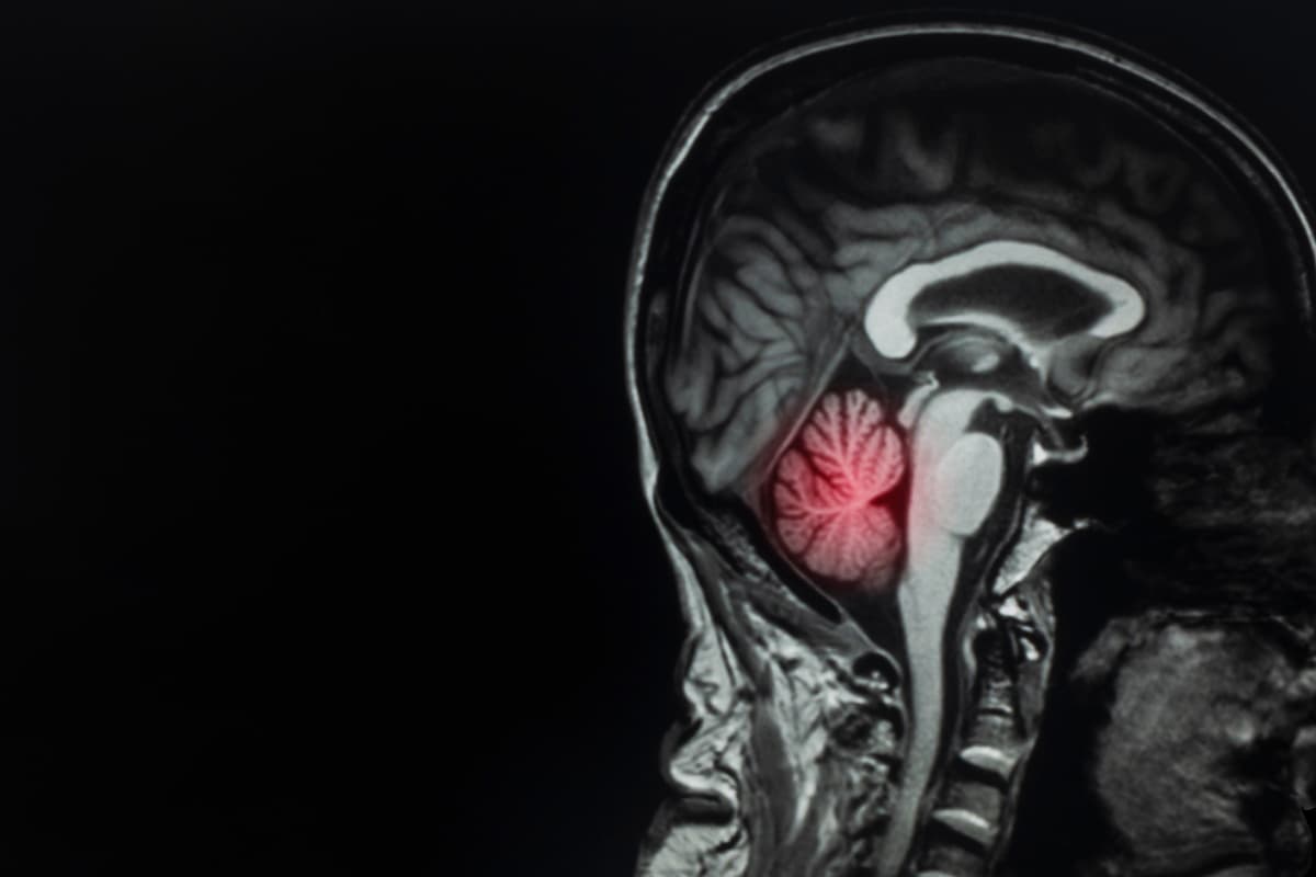 El extraño caso de seis empleados del mismo piso de un hospital que desarrollaron tumores cerebrales