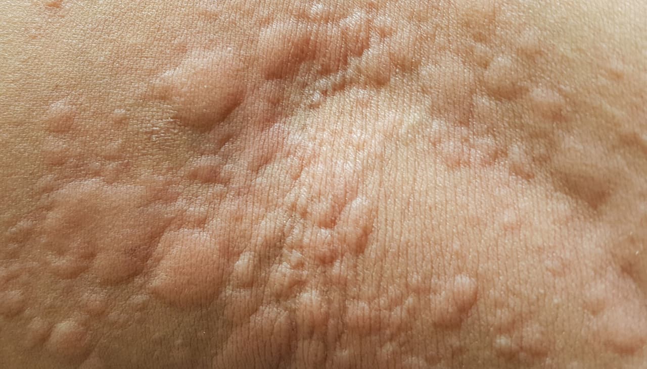 Tienes más posibilidades de sufrir urticaria si presentas ciertos antecedentes