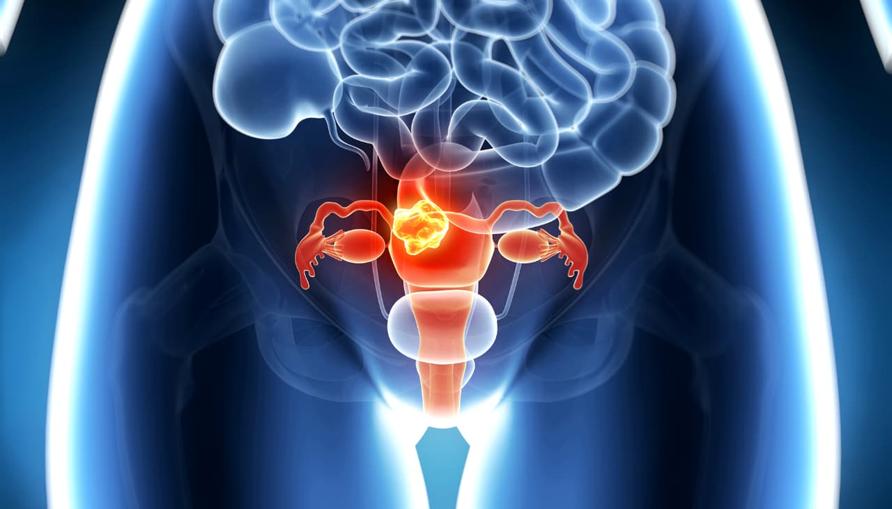 4 preocupantes enfermedades que podrías estar confundiendo con cólicos menstruales